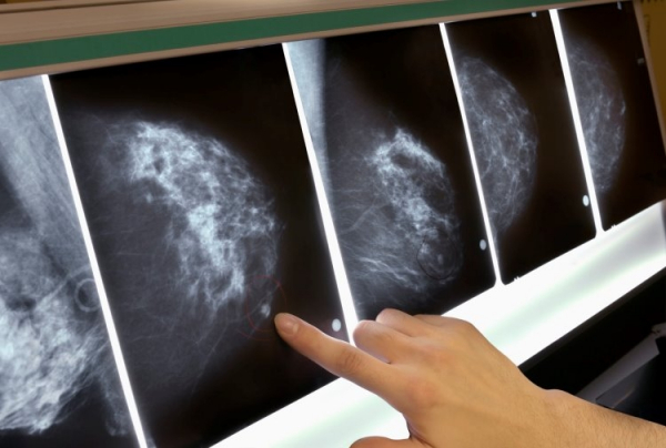 Учёные из MIT научили ИИ-систему предсказывать рак груди