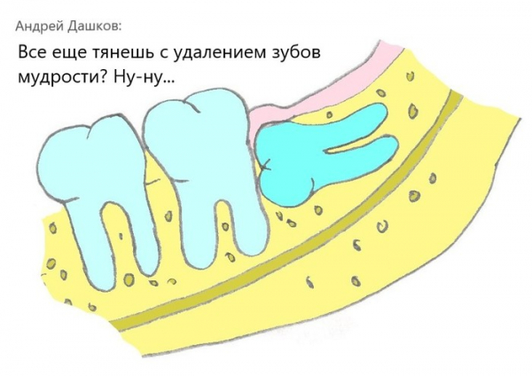 Последствия несвоевременного удаления зубов мудрости