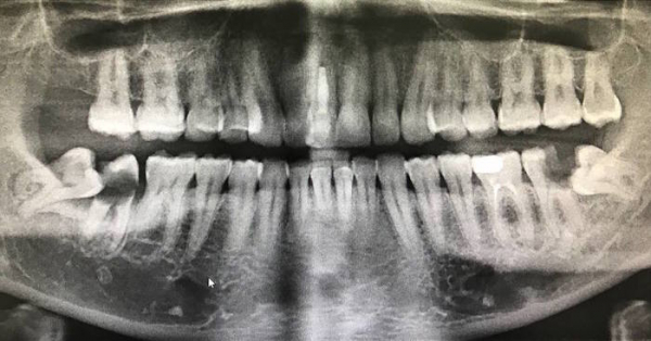 Последствия несвоевременного удаления зубов мудрости