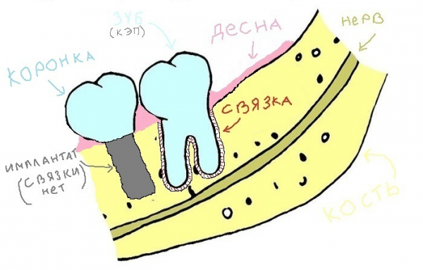 Синус-лифтинг и одномоментная имплантация